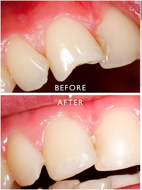 Witness the amazing before and after of a dental implant at top Cosmetic Dentistry in Indore.